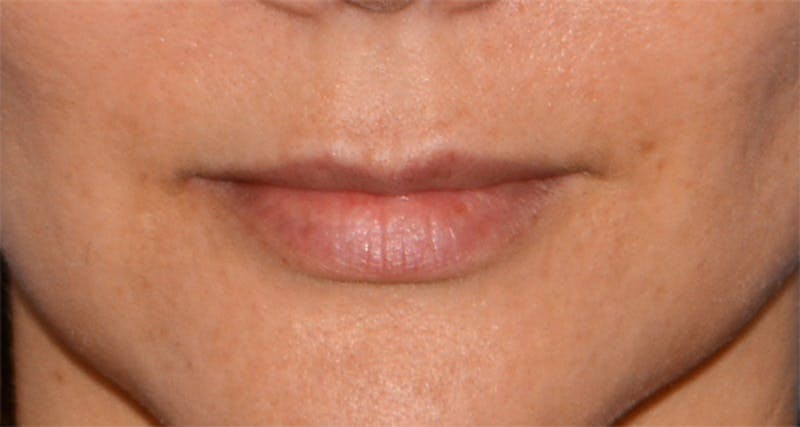Lip Augmentation Before & After Gallery - Patient 207174 - Image 3