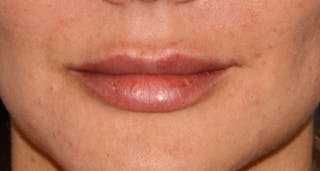 Lip Augmentation Before & After Gallery - Patient 207174 - Image 4