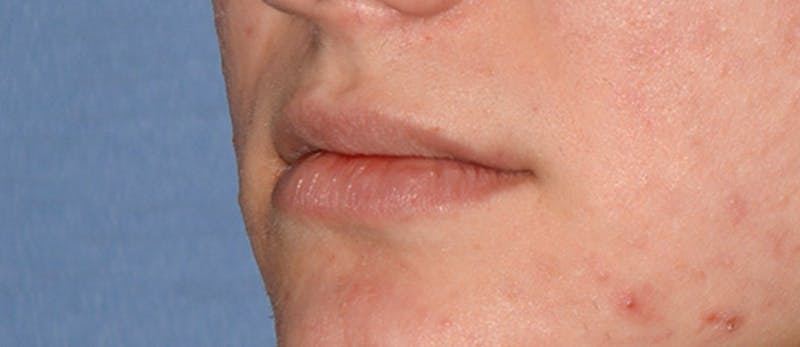 Lip Augmentation Before & After Gallery - Patient 883440 - Image 1
