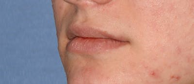 Lip Augmentation Before & After Gallery - Patient 883440 - Image 1