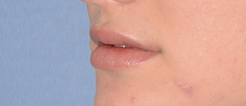 Lip Augmentation Before & After Gallery - Patient 883440 - Image 2