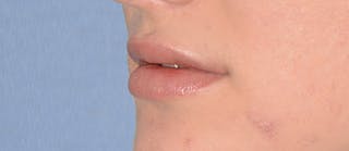 Lip Augmentation Before & After Gallery - Patient 883440 - Image 2