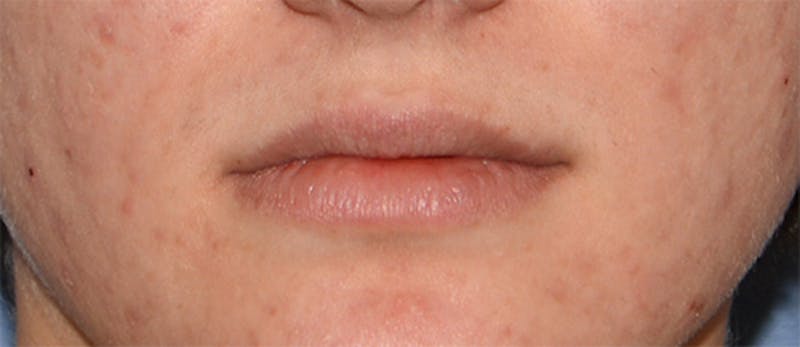 Lip Augmentation Before & After Gallery - Patient 883440 - Image 3