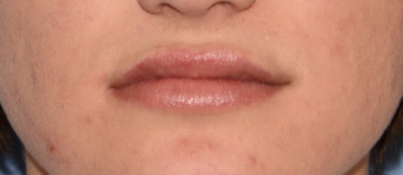 Lip Augmentation Before & After Gallery - Patient 883440 - Image 4