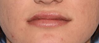 Lip Augmentation Before & After Gallery - Patient 883440 - Image 4
