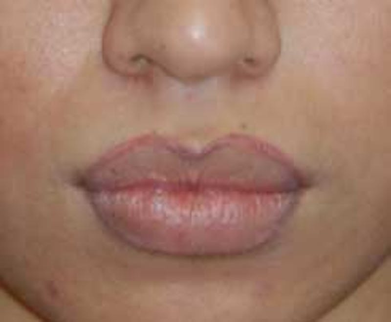 Lip Augmentation Before & After Gallery - Patient 397268 - Image 1