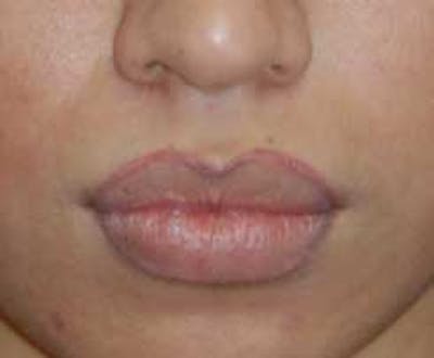 Lip Augmentation Before & After Gallery - Patient 397268 - Image 1