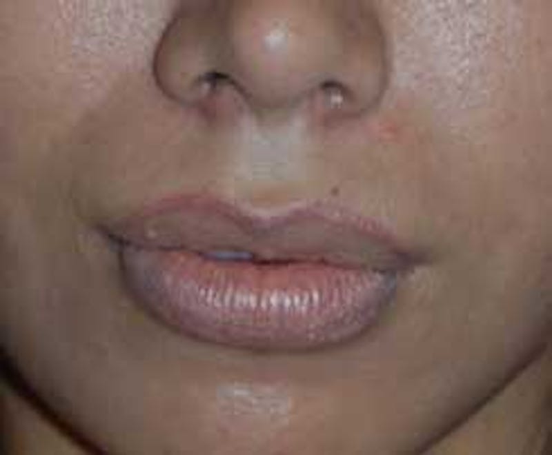Lip Augmentation Before & After Gallery - Patient 397268 - Image 2