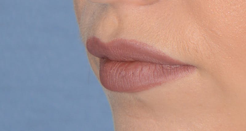 Facial Fillers / Injectables Before & After Gallery - Patient 232194 - Image 1