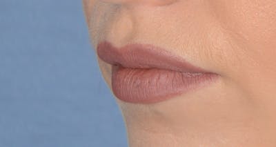 Lip Augmentation Before & After Gallery - Patient 383999 - Image 1