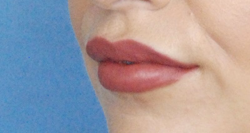 Facial Fillers / Injectables Before & After Gallery - Patient 232194 - Image 2