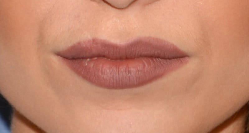 Facial Fillers / Injectables Before & After Gallery - Patient 232194 - Image 3