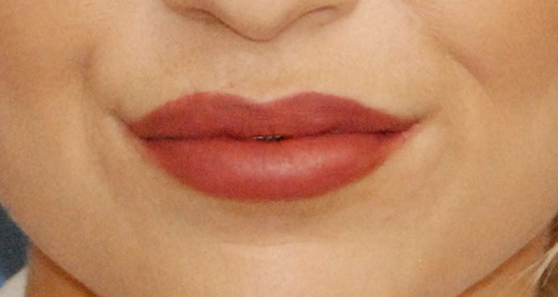 Facial Fillers / Injectables Before & After Gallery - Patient 232194 - Image 4