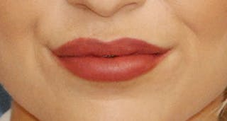 Lip Augmentation Before & After Gallery - Patient 383999 - Image 4