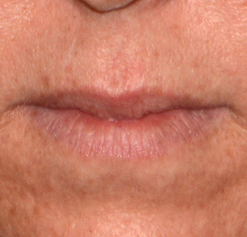 Lip Augmentation Before & After Gallery - Patient 375227 - Image 1