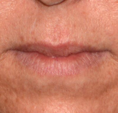 Lip Augmentation Before & After Gallery - Patient 375227 - Image 1