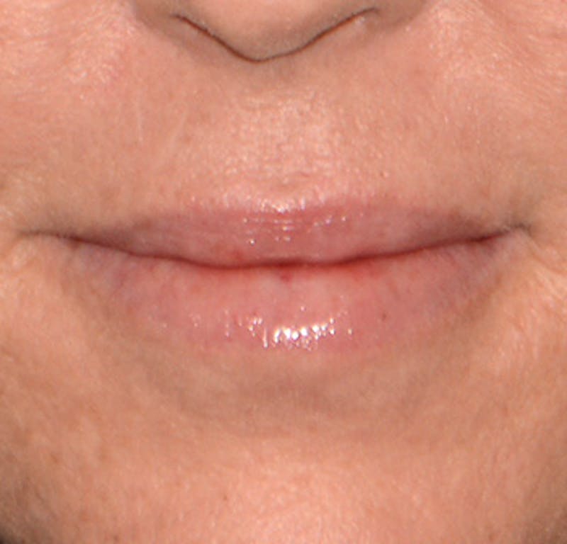 Lip Augmentation Before & After Gallery - Patient 375227 - Image 2
