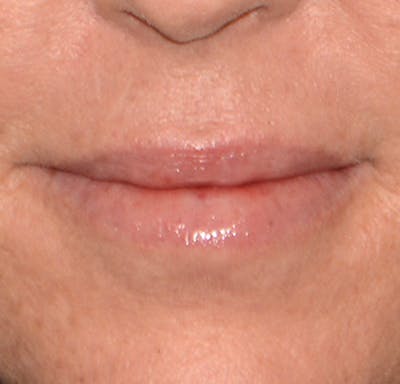 Lip Augmentation Before & After Gallery - Patient 375227 - Image 2