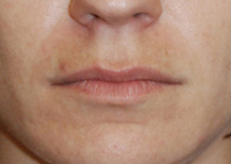 Lip Augmentation Before & After Gallery - Patient 344291 - Image 1
