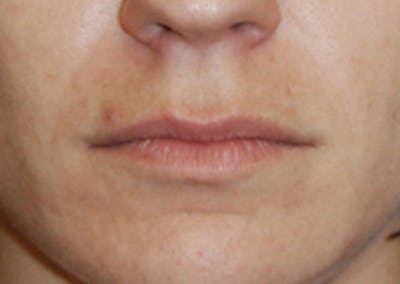 Lip Augmentation Before & After Gallery - Patient 344291 - Image 1