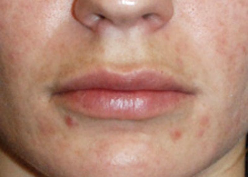 Lip Augmentation Before & After Gallery - Patient 344291 - Image 2