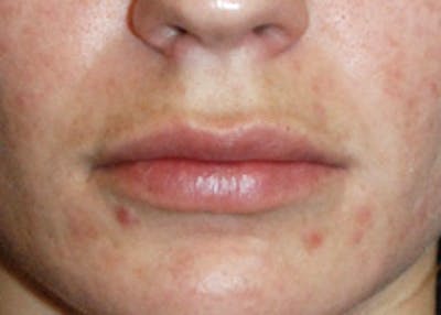 Lip Augmentation Before & After Gallery - Patient 344291 - Image 2