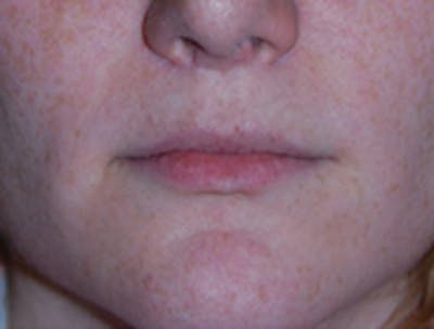 Lip Augmentation Before & After Gallery - Patient 187845 - Image 1