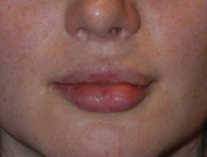 Lip Augmentation Before & After Gallery - Patient 187845 - Image 2