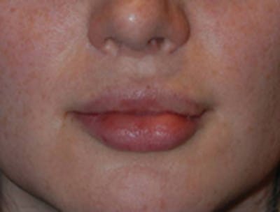 Lip Augmentation Before & After Gallery - Patient 187845 - Image 2