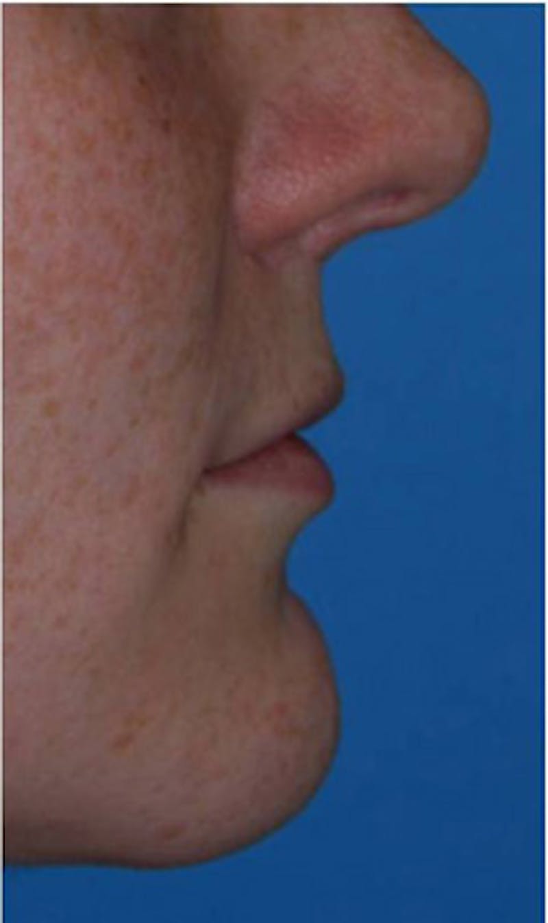 Lip Augmentation Before & After Gallery - Patient 187845 - Image 3