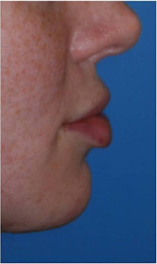 Lip Augmentation Before & After Gallery - Patient 187845 - Image 4