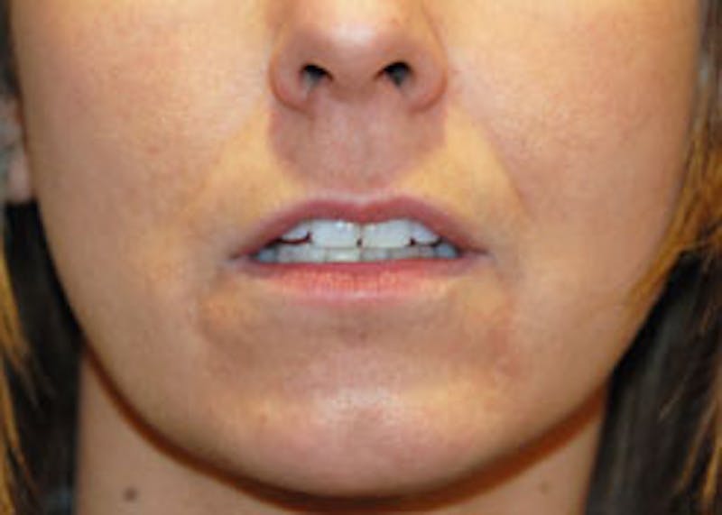 Lip Augmentation Before & After Gallery - Patient 282734 - Image 1