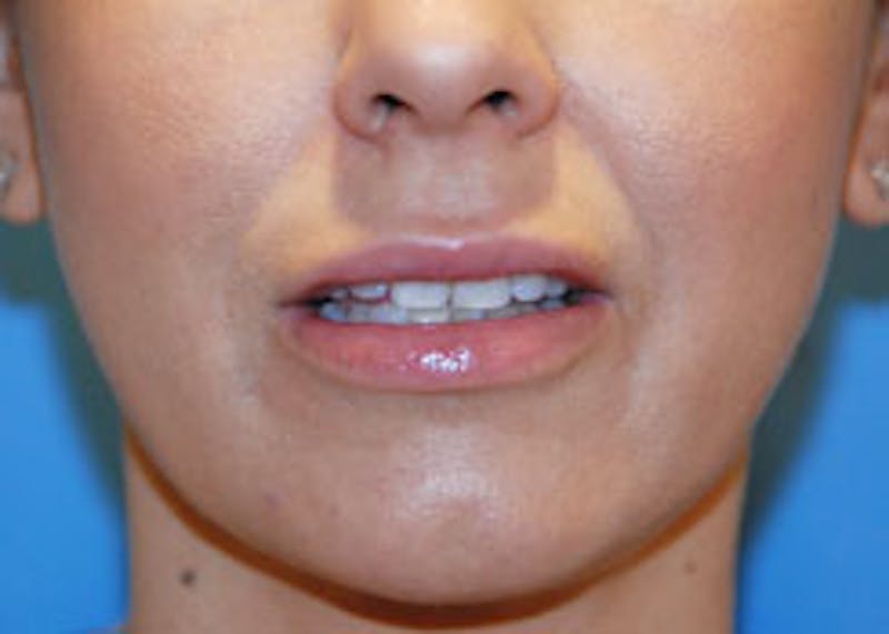 Lip Augmentation Before & After Gallery - Patient 282734 - Image 2