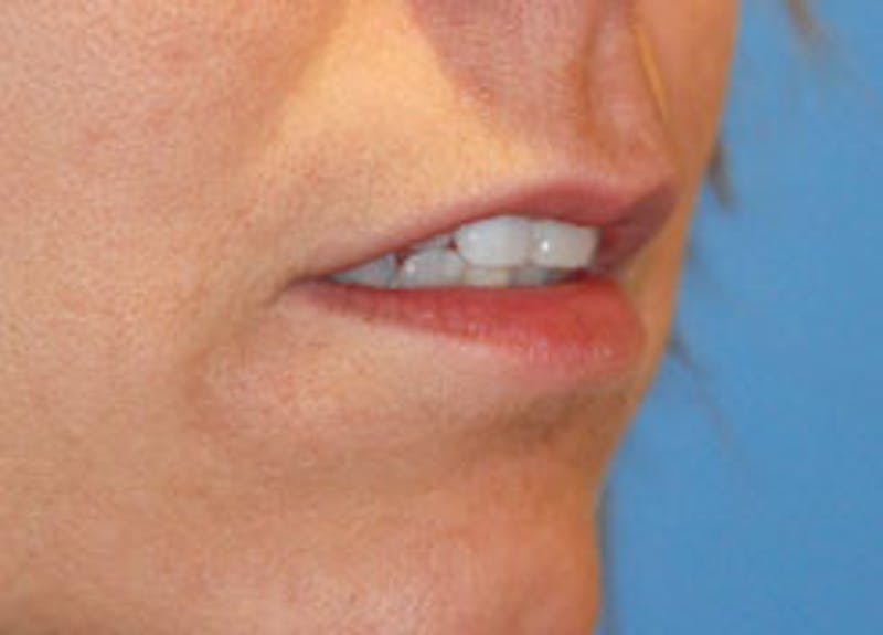 Lip Augmentation Before & After Gallery - Patient 282734 - Image 3