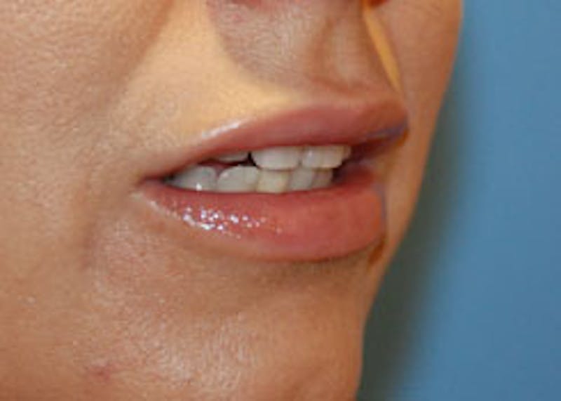 Lip Augmentation Before & After Gallery - Patient 282734 - Image 4