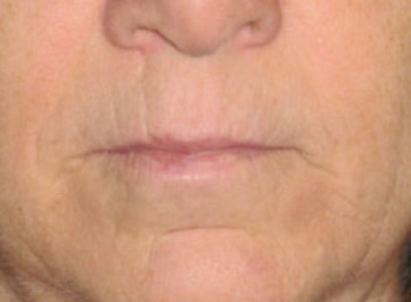 Facial Fillers / Injectables Before & After Gallery - Patient 125870 - Image 1