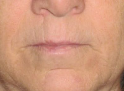 Lip Augmentation Before & After Gallery - Patient 366985 - Image 1
