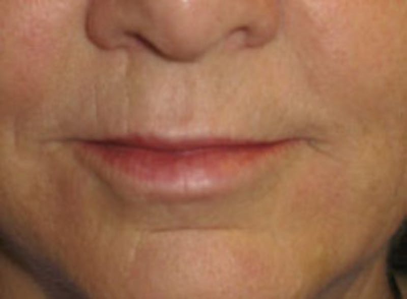 Facial Fillers / Injectables Before & After Gallery - Patient 125870 - Image 2