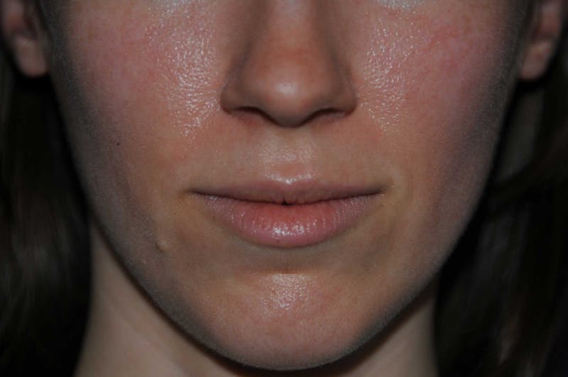 Lip Augmentation Before & After Gallery - Patient 150939 - Image 1
