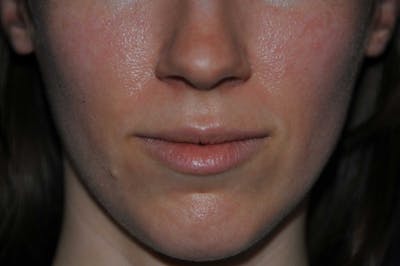 Lip Augmentation Before & After Gallery - Patient 150939 - Image 1