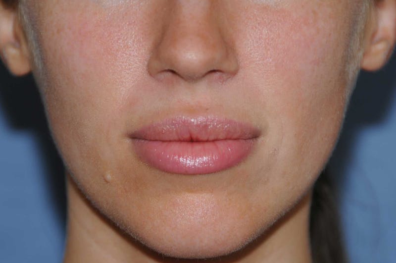 Lip Augmentation Before & After Gallery - Patient 150939 - Image 2