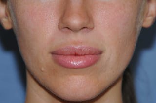 Lip Augmentation Before & After Gallery - Patient 150939 - Image 2