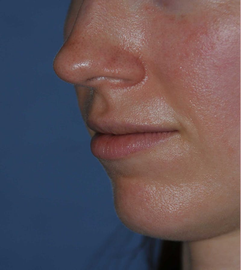 Lip Augmentation Before & After Gallery - Patient 150939 - Image 3