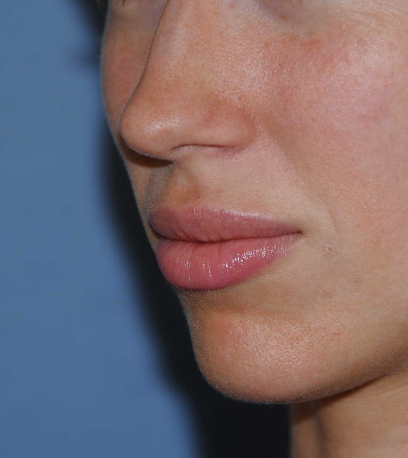 Lip Augmentation Before & After Gallery - Patient 150939 - Image 4
