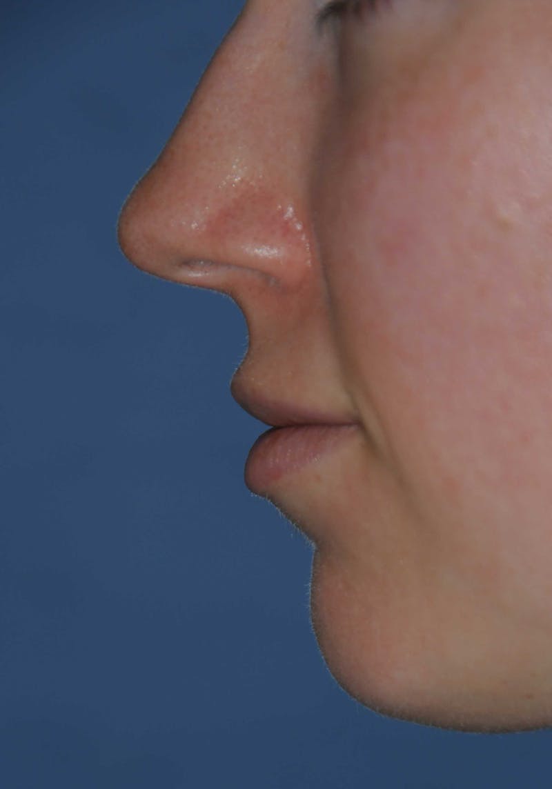 Lip Augmentation Before & After Gallery - Patient 150939 - Image 5