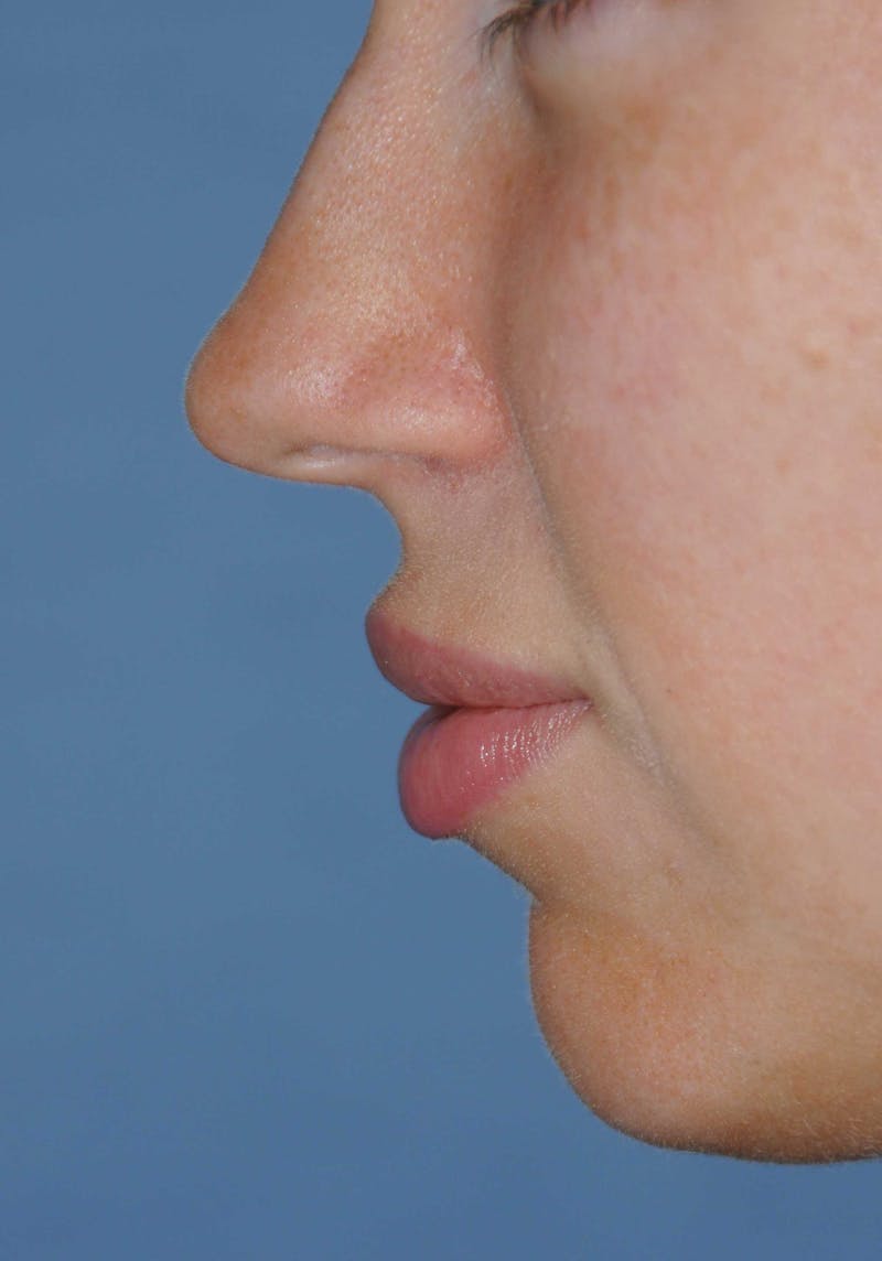 Lip Augmentation Before & After Gallery - Patient 150939 - Image 6