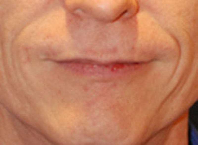 Lip Augmentation Before & After Gallery - Patient 422348 - Image 1