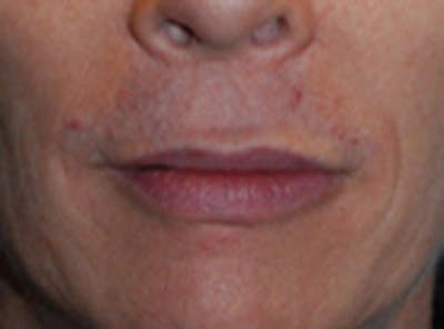 Lip Augmentation Before & After Gallery - Patient 422348 - Image 2