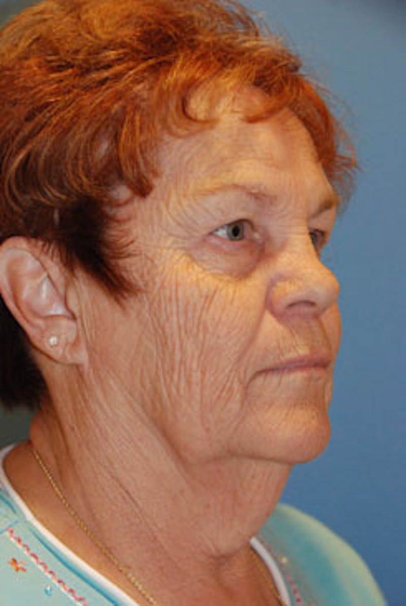 Liposuction Before & After Gallery - Patient 457551 - Image 1