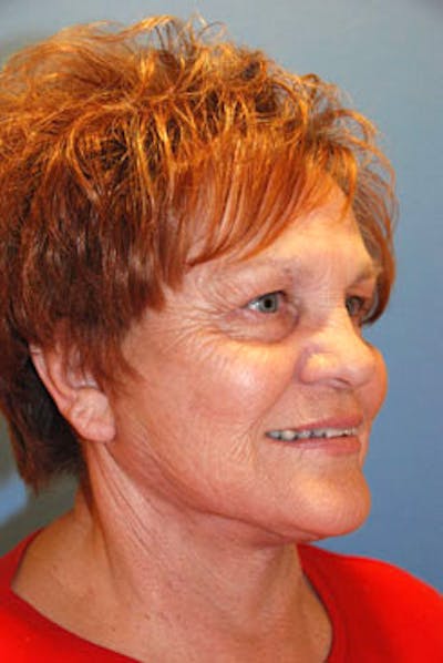 Liposuction Before & After Gallery - Patient 457551 - Image 2